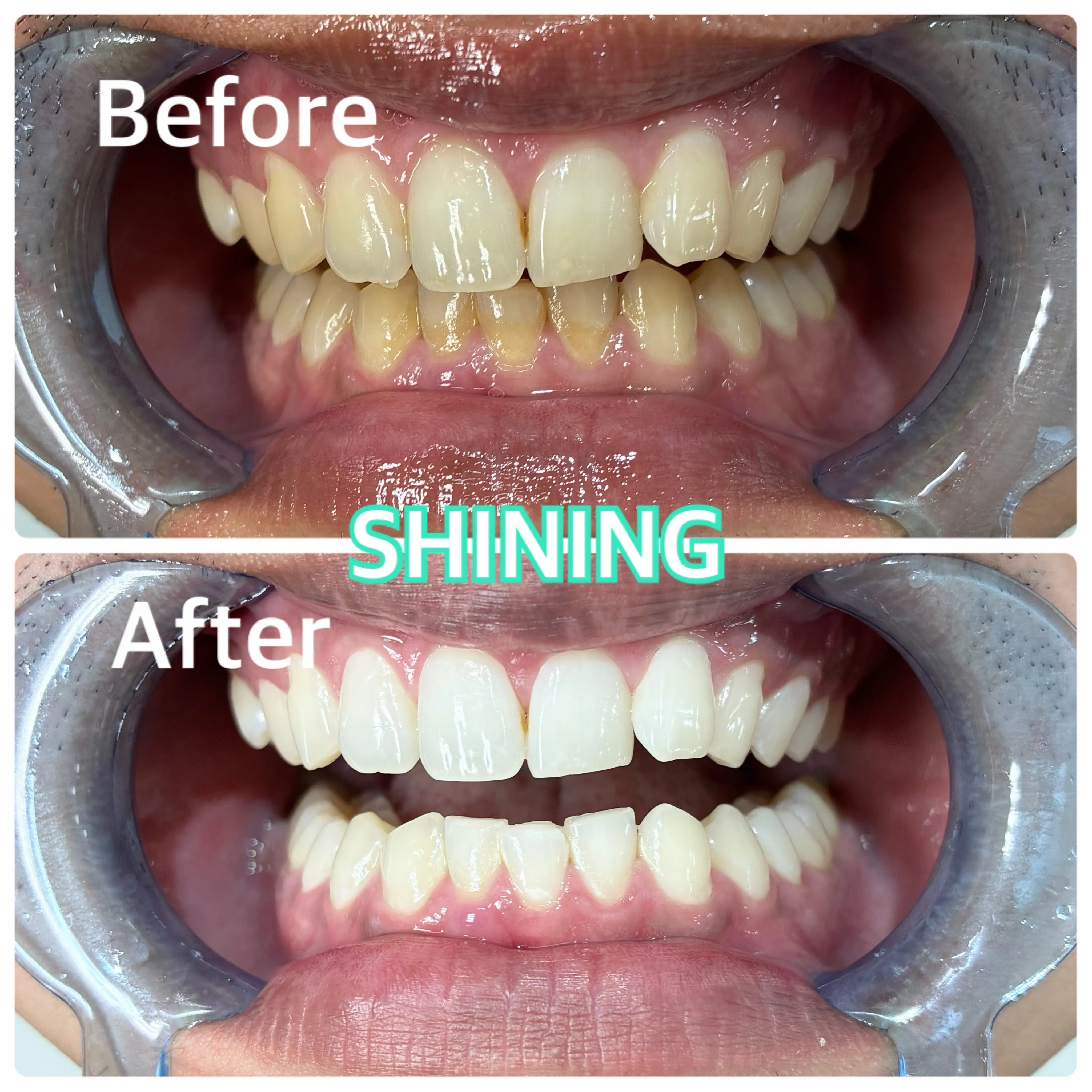 【ホワイトニングBefore After】